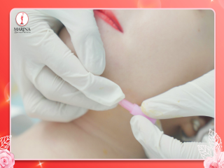 Tiêm giảm mỡ nọng cằm liệu có an toàn?